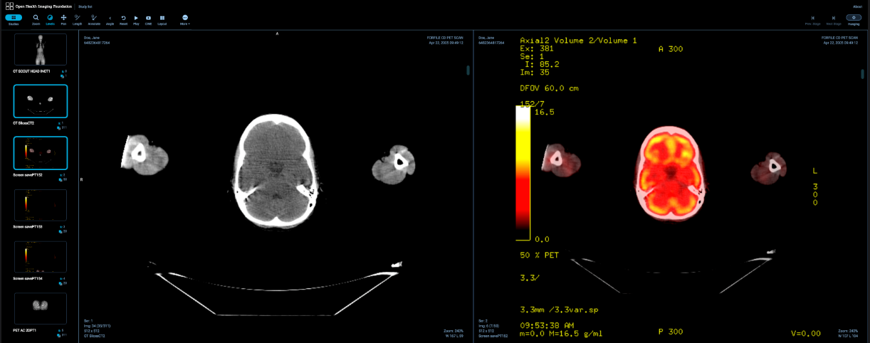 Fusión PET-CT